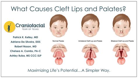 What Causes Cleft Lips and Palates? - Dell Children's Craniofacial Team ...