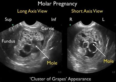 Molar Pregnancy, Hydatidiform Mole - Causes, Symptoms, Treatment