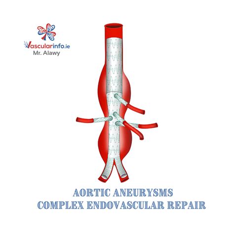 Endovascular AAA Repair - Vascular Info