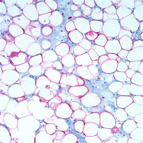 Image - S100.red.adipose tissue.200x.jpg | Pathology Resident Wiki ...