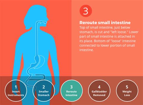 Duodenal Switch (DS) Surgery - 14 Ways It Will Affect You - Bariatric ...