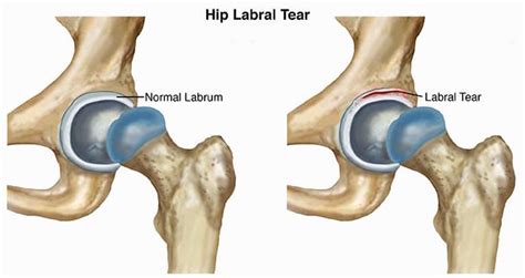 Hip Injury: Acetabular Labral Tears