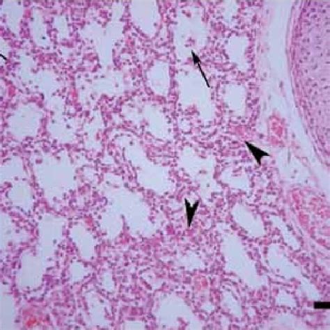 Desquamation of the epithelial cells (arrows) and atelectatic areas ...