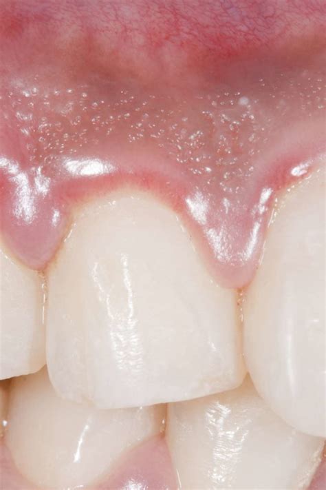 Swollen gums: Causes, treatments, and home remedies