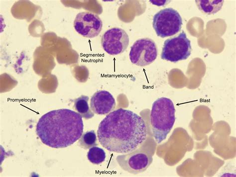 promyelocytes and blasts - Google Search | Hemoterapia, Células ...