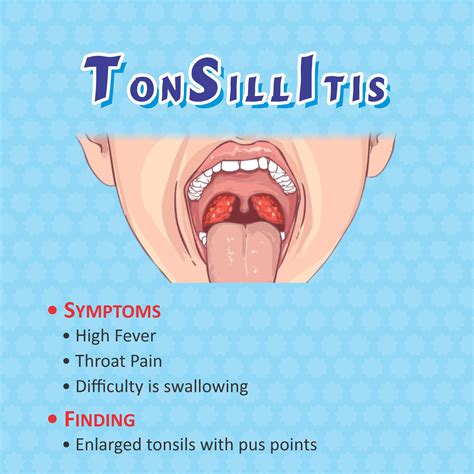 723 Images Of Viral Tonsillitis Pics - MyWeb