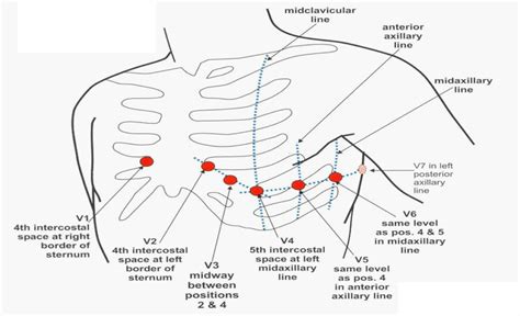 precordial-leads - Cardiac Sciences Manitoba