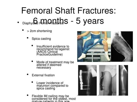 Pediatric Femur Fracture