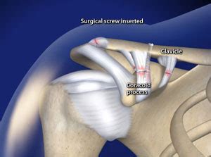 Arthroscopic Acromioclavicular (AC) Joint Separation Repair in Plano ...