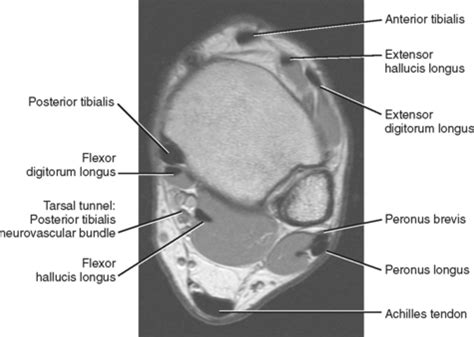 Foot Muscles Mri Anatomy / Get Mri Calf Anatomy Images - Roda Dunia ...