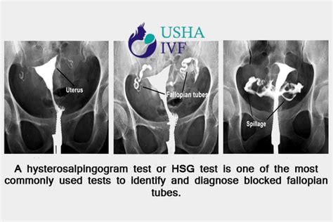 Tubal Testing by HSG | Hysterosalpingogram, HSG Test for Tubal Infertility