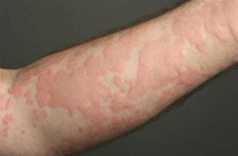 URTICARIA OR HIVES Hives (urticaria) are red