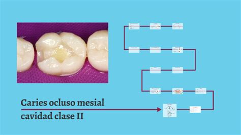 Caries ocluso mesial cavidad clase II by Lidia Martin on Prezi