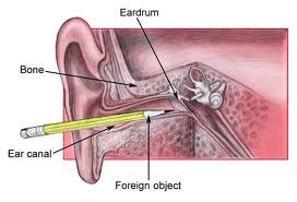 Tympanic Membrane Rupture | Dr. Thind