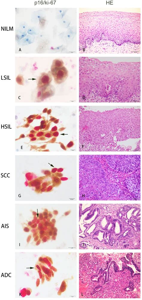 Frontiers | Significance of Triple Detection of p16/ki-67 Dual-Staining ...