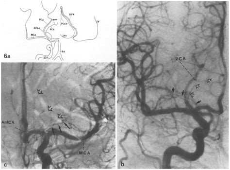 a-c. a Anterior-Posterior Schematic Angiogram. This diagram ...