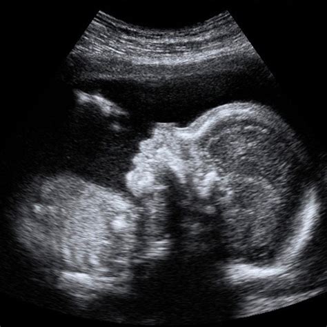 28 Week Fetus Ultrasound