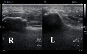 Ultrasound Images of Plantar Fasciitis - Ankle, Foot and Orthotic Centre