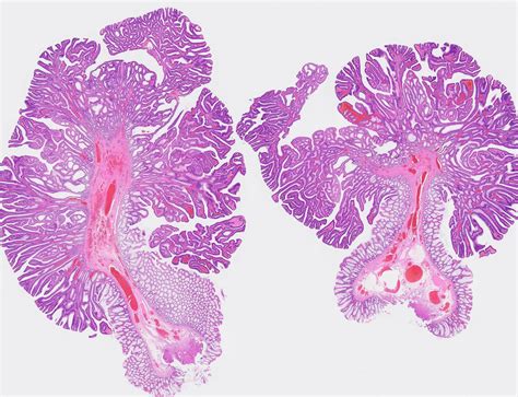 Pathology Outlines - Tubulovillous / villous adenoma