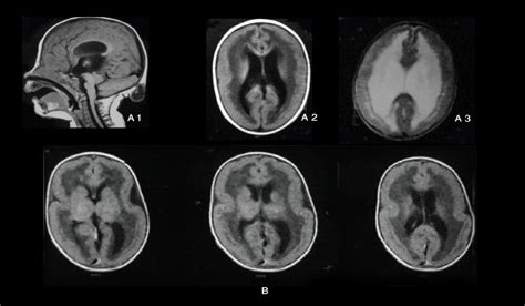 Cobblestone lissencephaly. A: Case 18: Axial and Sagittal T1 and Axial ...