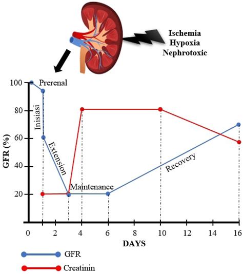 The relationship between GFR and serum creatinine (SCr) in the AKI ...