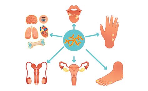 Body Parts Fungal Skin Infection Can Affect - Causes and Treatment of ...