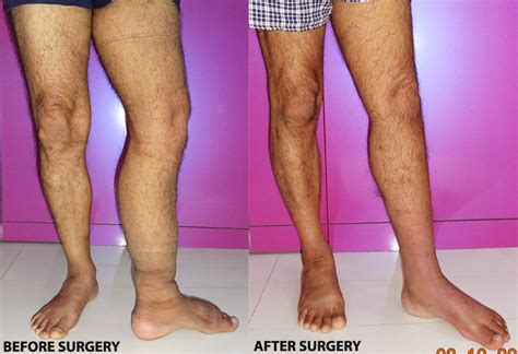 Rare Surgery on Elephantiasis Done by City's Renowned Plastic Surgeon ...