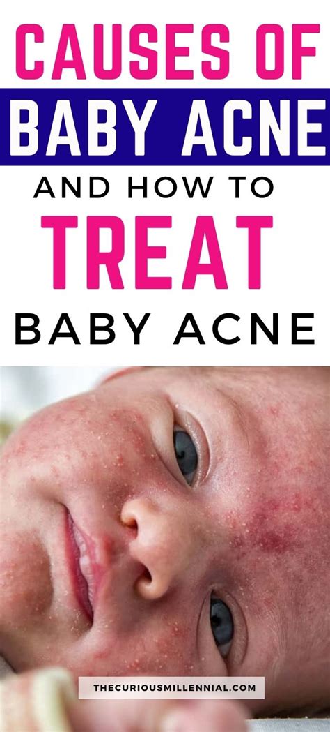 Baby Acne: Causes, Symptoms, And Treatment - The Curious Millennial