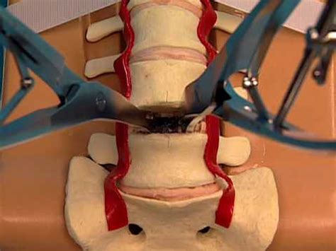 ProDisc Lumbar Total Disc Replacement Saw Bones Technique Video - YouTube