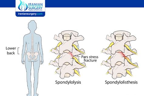 Spondylolysis | Iranian Surgery