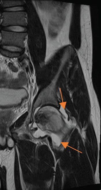 T2 MRI views of the left hip: coronal view (a) and axial view (b) of ...