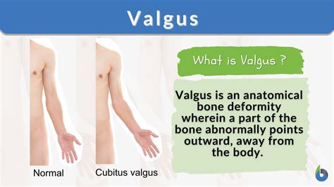 Valgus Vs Varus Of Ankle