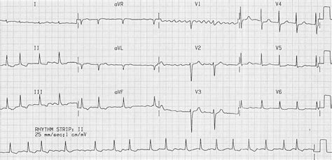 Atrial Fibrillation • LITFL • ECG Library Diagnosis