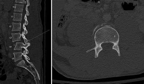 Traumatic Bilateral L3-4 Facet Dislocation With Open Decompression and ...