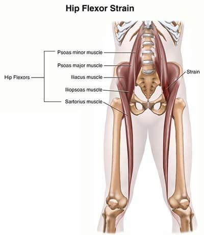 Hip Flexor Strain Treatment Doctors (Hip Pain Specialists) Brooklyn NY