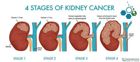 CAR-T Cell Immunotherapy & Stem Cells for Kidney Cancer RCC