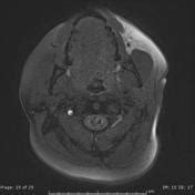 Vertebral Artery Dissection Mri