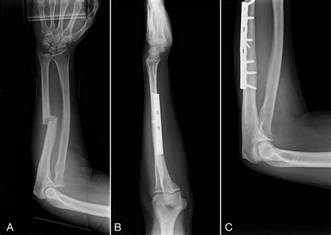 Broken Arm: Signs, Symptoms, & Treatments - Orthopedic & Sports Medicine