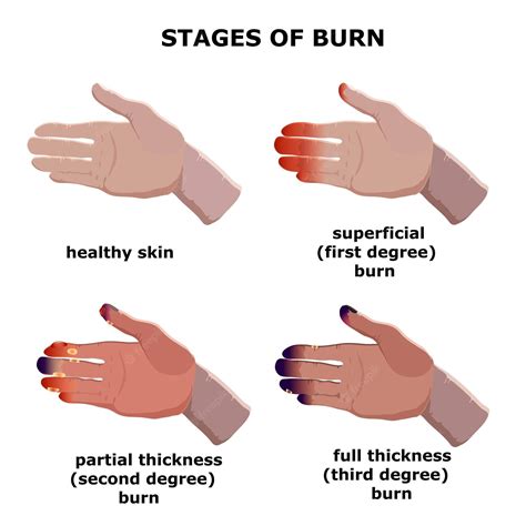 Burn: Types, Treatment, and Nursing Management - Medical Surgical ...