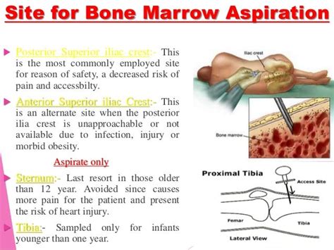 Posterior Iliac Crest Bone Marrow Biopsy