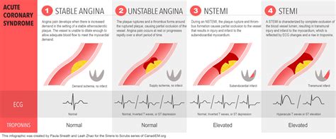 Acute Coronary Syndrome (ACS) Definitions - Stable Angina, Unstable ...