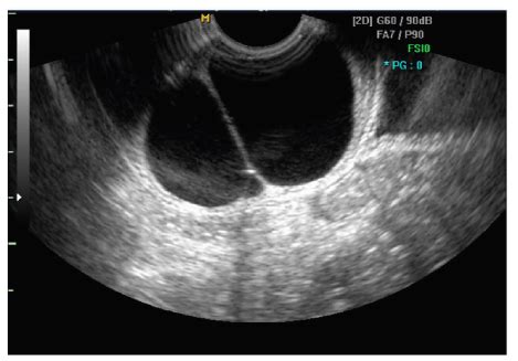 Large nabothian cyst with chronic pelvic pain: case report and ...