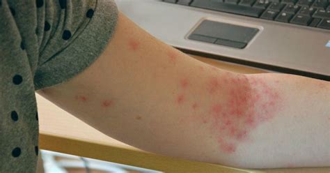 What Are Petechiae and Causes of Petechiae?