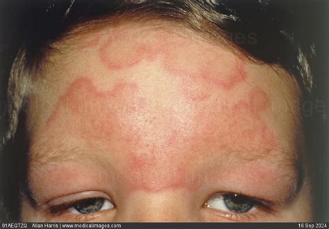 STOCK IMAGE, close-up of urticaria hives showing an acute urticarial ...