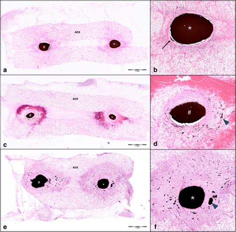 Histologic analysis of arteriovenous shunts. Histologic analysis of ...