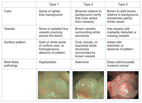 Mucosal imaging in colon polyps: New advances and what the future may hold