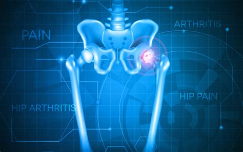 Understanding Arthritis of the Hip and How To Treat It | Mahwah Valley ...