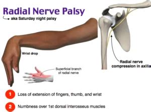 Radial Nerve Injury Cause, Symptom, Physiotherapy Treatment