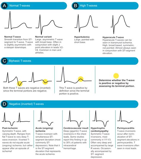 ECG interpretation: Characteristics of the normal ECG (P-wave, QRS ...