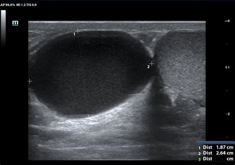 Epididymal Cyst Ultrasound